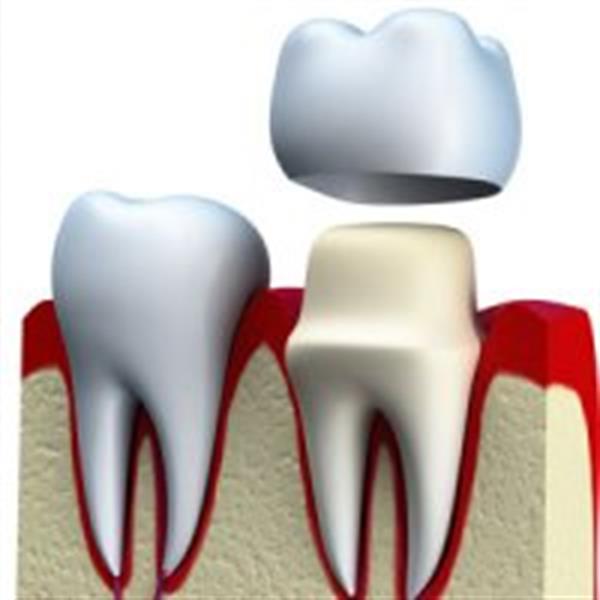 روکش های دندانی تا چند سال ماندگاری دارند؟